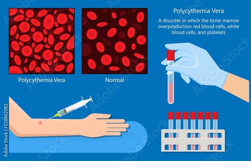 Polycythemia vera PV blood clots cancer bone marrow diagnostic complete count venous thromboses