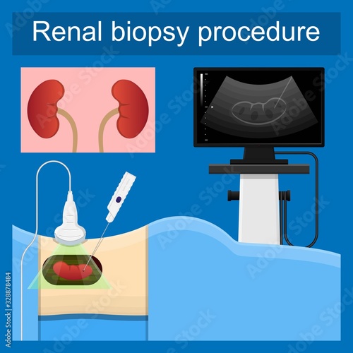 Renal Biopsy procedure kidney tissue lab diagnose examination Fine needle aspiration FNA urinary tract infection