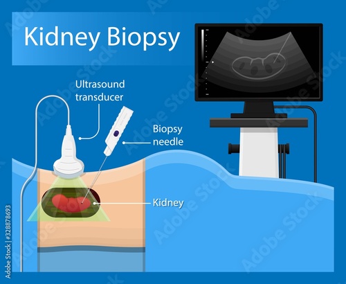 Renal Biopsy procedure kidney tissue lab diagnose examination Fine needle aspiration FNA urinary tract infection
