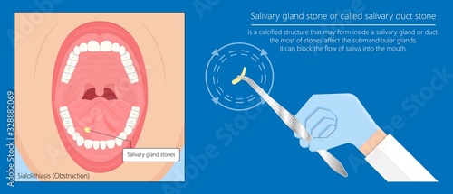 Parotid gland Sialadenitis bacterial infection Sialolithiasis blockage swelling treat Infiltrative cancer ear nose doctor calculi stones diagnose surgical examination inflammation saliva