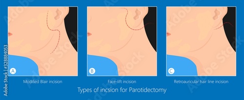 Parotid gland Sialadenitis bacterial infection Sialolithiasis blockage swelling treat Infiltrative cancer ear nose doctor calculi stones diagnose surgical examination inflammation saliva