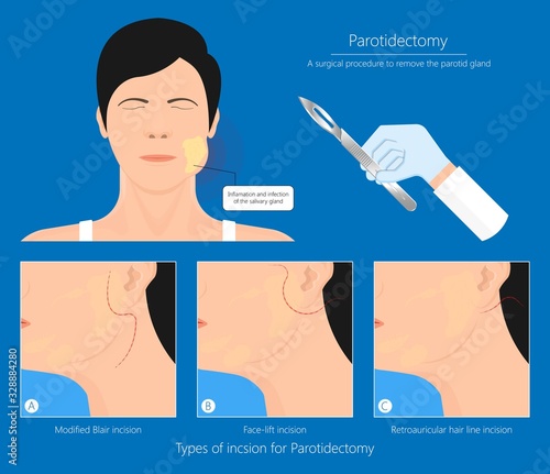 Parotid gland Sialadenitis bacterial infection Sialolithiasis blockage swelling treat Infiltrative cancer ear nose doctor calculi stones diagnose surgical examination inflammation saliva
