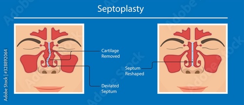 Septoplasty deviated nasal septum breath block blocked swell Nosebleed