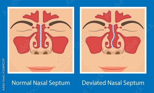 Septoplasty deviated nasal septum breath block blocked swell Nosebleed