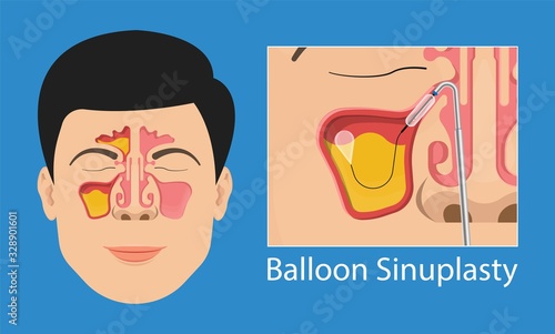 Sinusitis medical disease treat sinuses allergies surgical drug smart ENT endoscopy diagnose