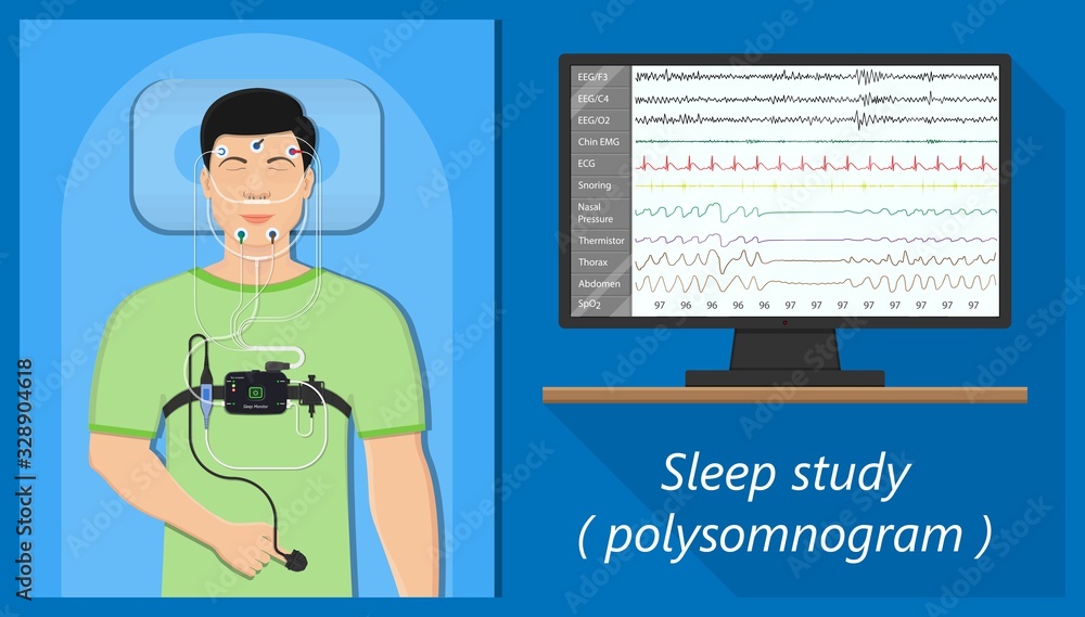 PSG sleep study test apnea diagnose Periodic limb movement disorder positive airway pressure