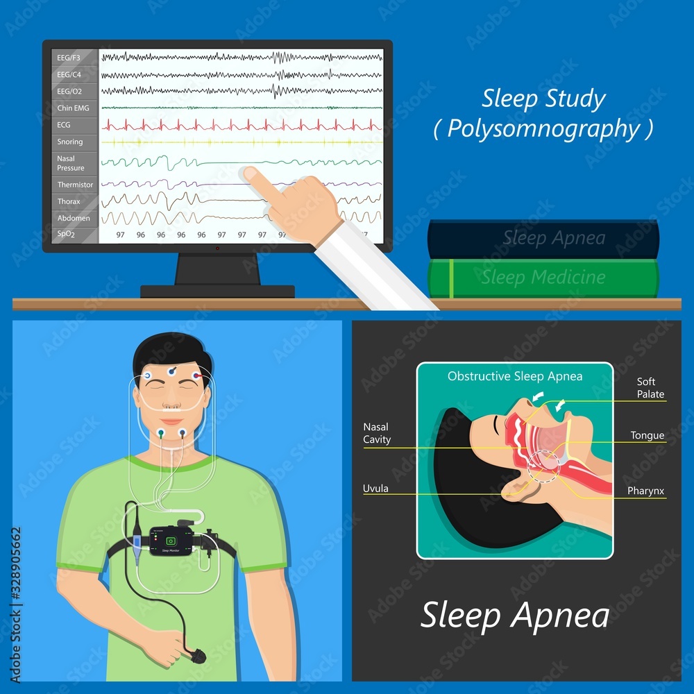 Fototapeta PSG sleep study test apnea diagnose Periodic limb movement