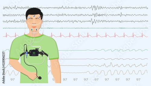 PSG sleep study test apnea diagnose Periodic limb movement disorder positive airway pressure CPAP restless leg syndrome Epworth Sleepiness Scale photo