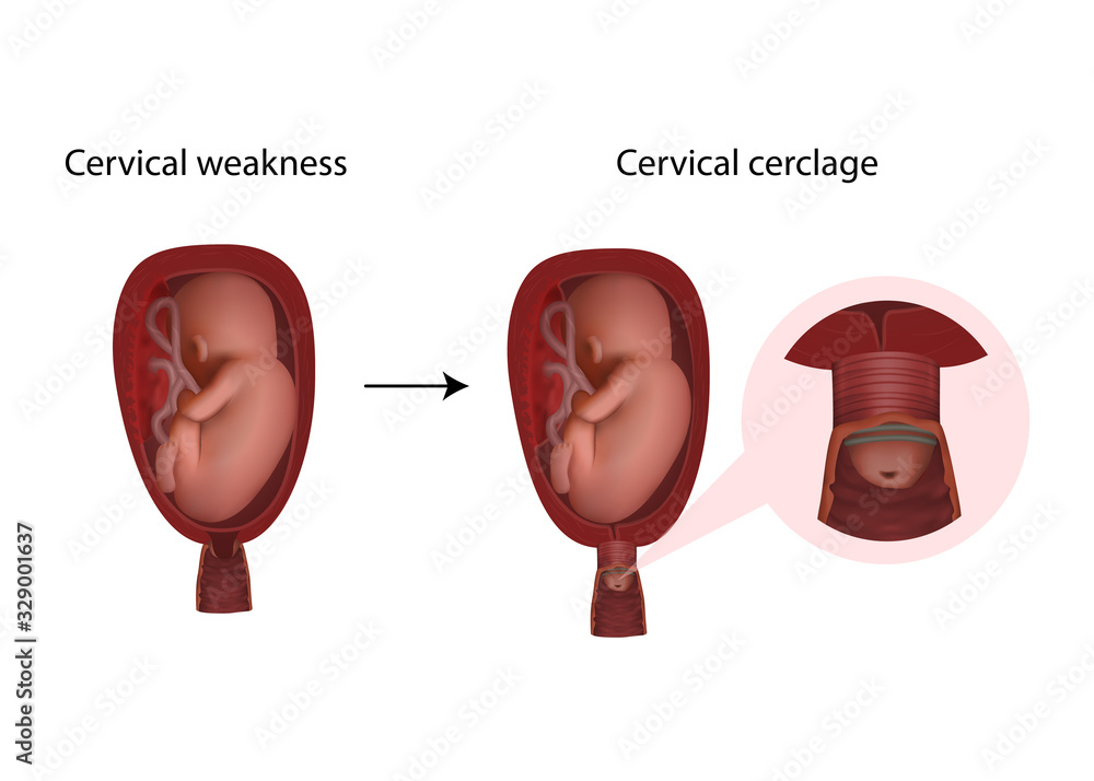 Cervical weakness treatment. Cervical cerclage. Fetus in uterus, womb