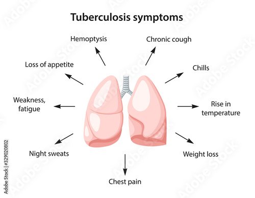 Tuberculosis symptoms as text. Image of human lungs. Vector illustration in flat style isolated over white background.