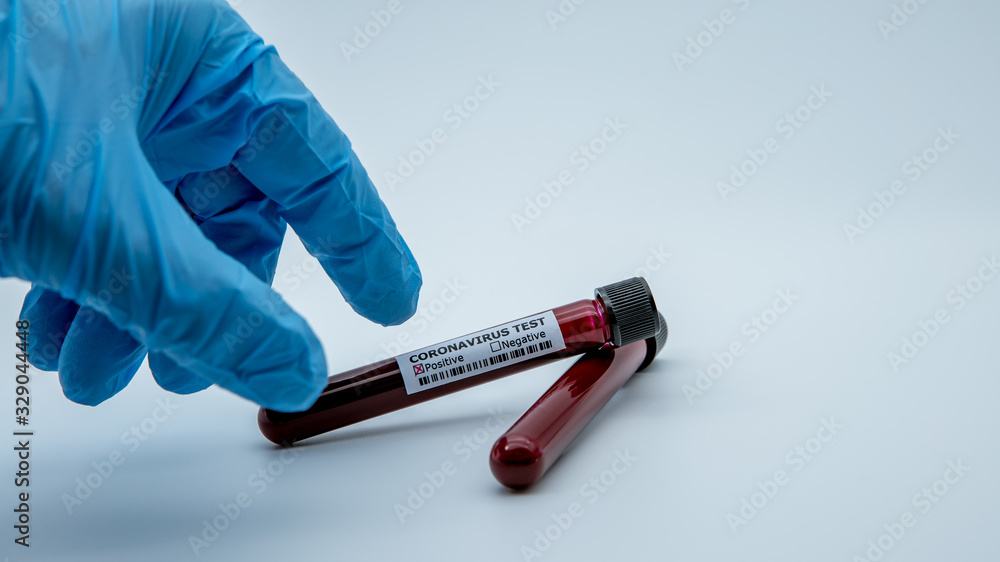 Obraz premium Positive COVID-19 test and laboratory sample blood testing for diagnosis