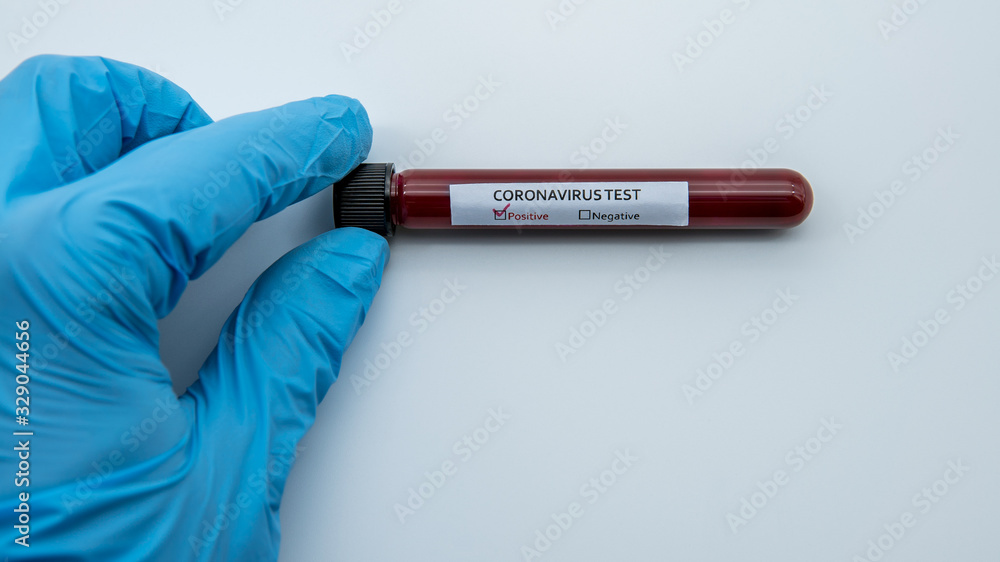 Obraz premium Positive COVID-19 test and laboratory sample blood testing for diagnosis