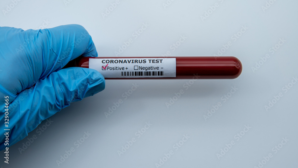 Obraz premium Test tube with infected blood sample for COVID-19, coronavirus from Wuhan