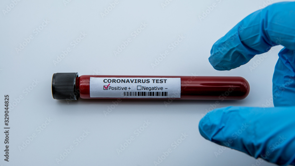 Obraz premium Positive COVID-19 test and laboratory sample blood testing for diagnosis