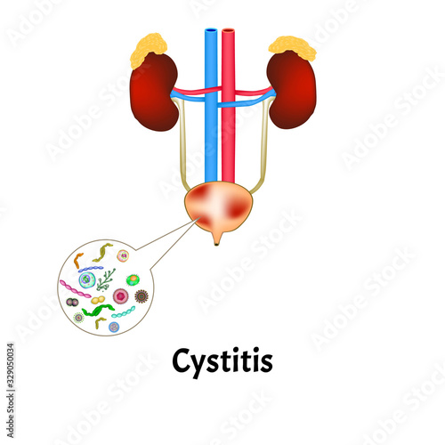Cystitis. Inflammation of the bladder. The structure of the kidneys and bladder. Excretory system. Infographics. Vector illustration on isolated background.