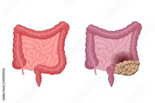 Human intestines anatomy strong healthy and unhealthy with colon cancer comparison. Abdominal cavity digestive and excretory internal organ oncology tumor. Vector digestion problem illustration