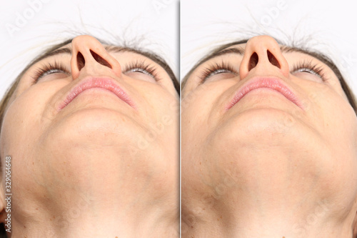 Deviated nasal septum before and after septoplasty surgery comparison