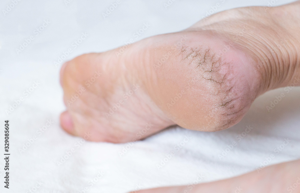 Dry cracked skin on the heels of a person s legs close up. The