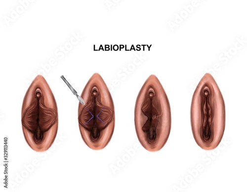 Illustration of the labioplasty. Before and after surgery photo