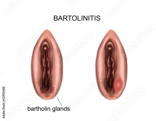 Illustration of the inflammation of the bartholin glands. bartholinitis