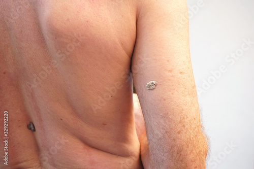 Back view of a Caucasian showing Seborrheic Keratosis at his right upper arm. The white mole has cracks. It is most common noncancerous skin growths in adults. Not contagious.