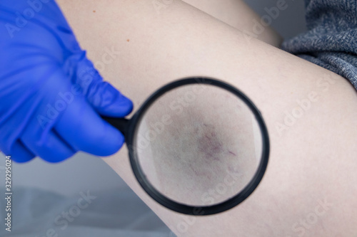 Schilderij op canvas A vascular surgeon examines a leg with varicose veins