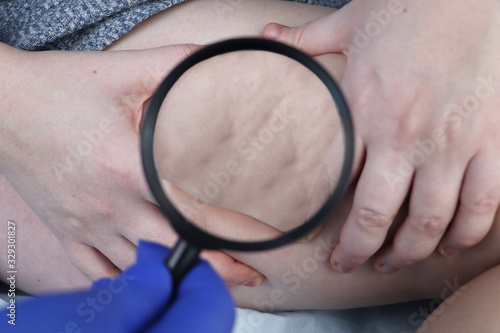 A doctor examines a patient’s leg with lipodystrophy. A magnifying glass shows cellulite. The concept of obesity and treatment of liposclerosis (orange peel)