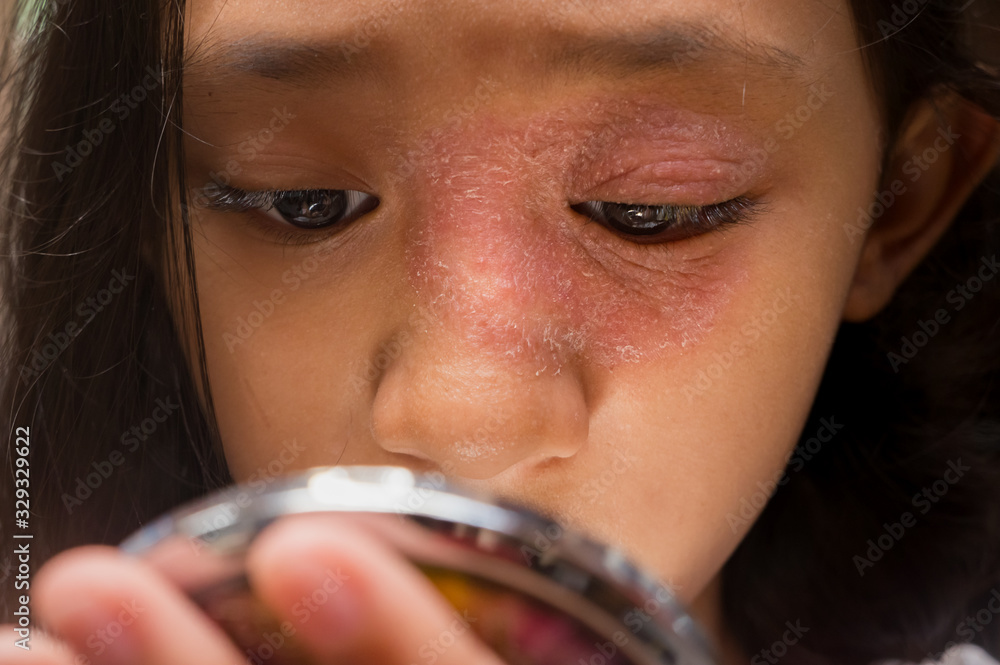 Southeast Asian Ethnicity Teenage Girl With Circular Shape Skin Rash On Her Face Around The Eye 3582