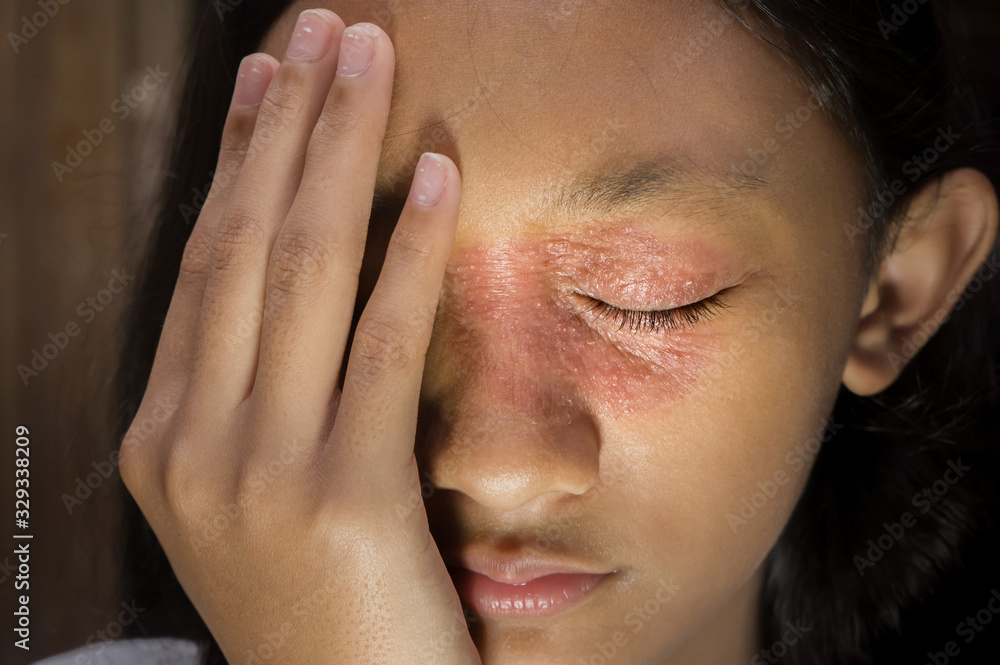 Southeast Asian ethnicity teenage girl with circular shape skin rash on her face around the eye and nose, Tinea corporis dermatitis skin problem Southeast Asian ethnicity teenage girl with circular shape skin rash on her face around the eye and nose, Tinea corporis dermatitis skin problem