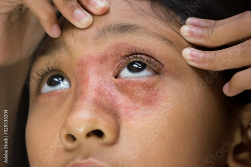 Southeast Asian ethnicity teenage girl with circular shape skin rash on her face around the eye and nose, Tinea Corporis dermatitis skin problem photo