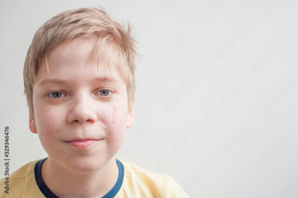 portrait of a small sad boy with abrasion, scratches on his cheek portrait of a small sad boy with abrasion, scratches on his cheek