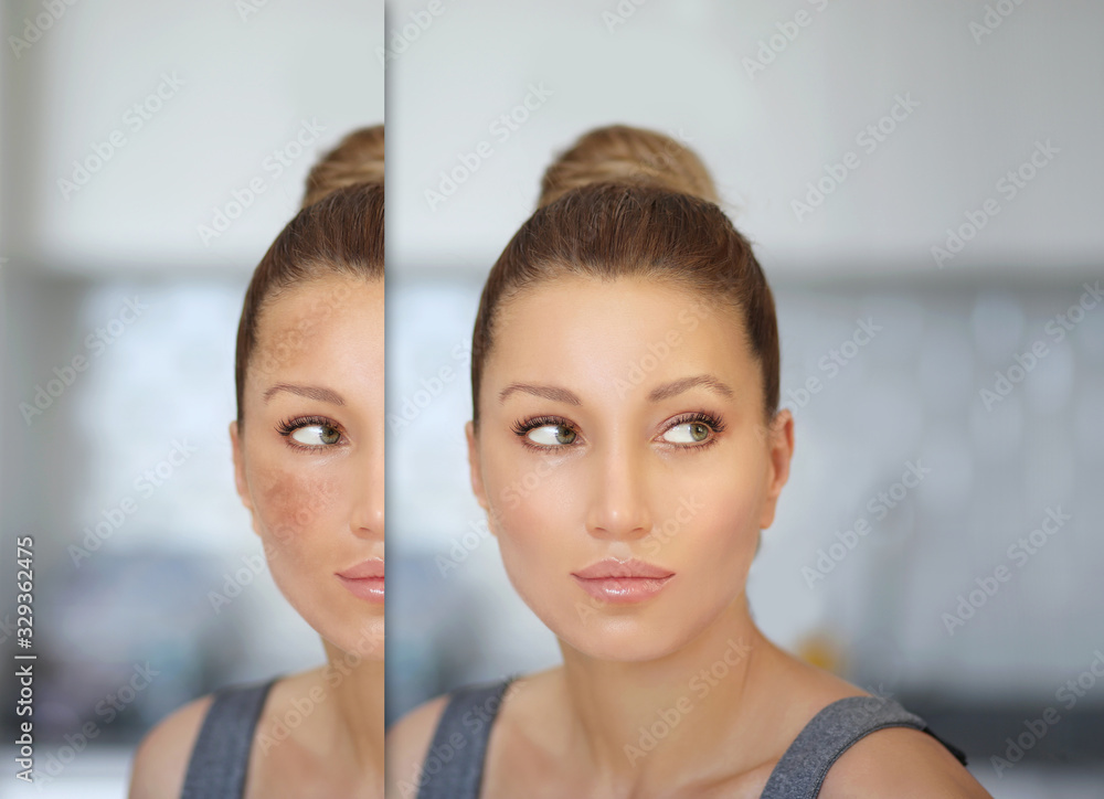 Dark spots, freckles,hyperpigmentation(melasma or chloasma) Dark spots, freckles,hyperpigmentation(melasma or chloasma)