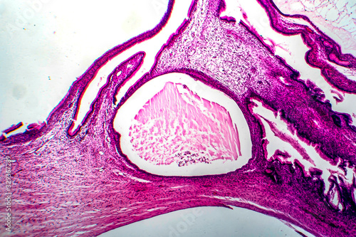 Ovarian mucinous cystadenoma, a benign tumor of ovary, light micrograph, photo under microscope photo