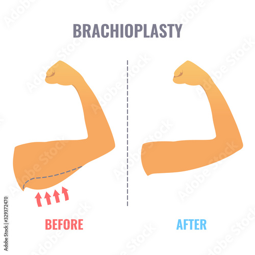 Brachioplasty medical infographic poster. Before and after result of arm lift aesthetic surgery. Body contouring procedure. Healthcare and medical concept. Vector illustration.