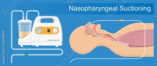 Suction adult nares unit lung clear fluid tube nose nasal pump treat nurse airway clinic device portable mucus oxygen emergency examination therapy sick anaesthetist pharynx pneumonia ventilation