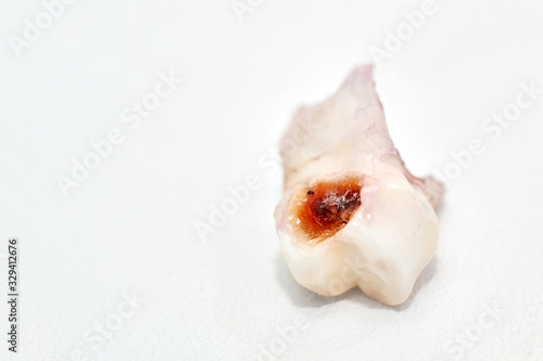 Dental caries on primary tooth. Deciduous tooth with caries on light background. Concept of visiting dentist regularly. Closeup, selective focus