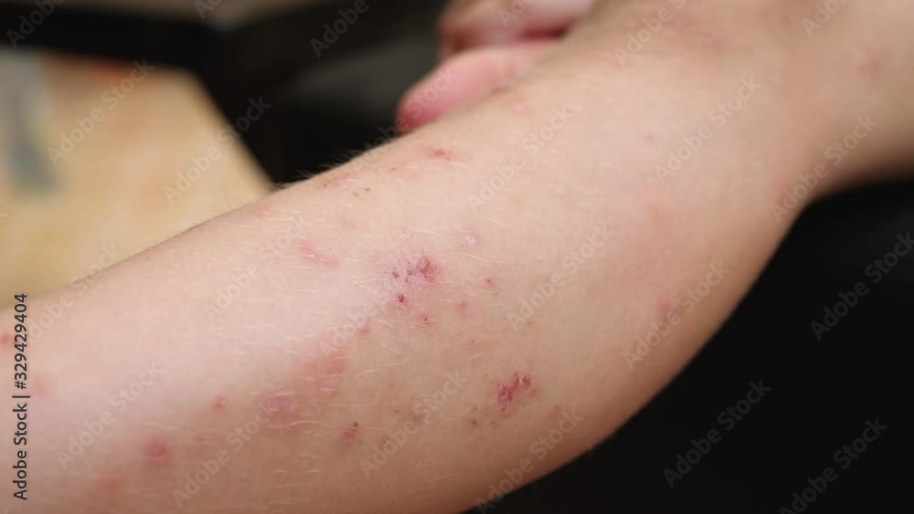 Decontamination and disinfection of wound on leg skin pouring cotton