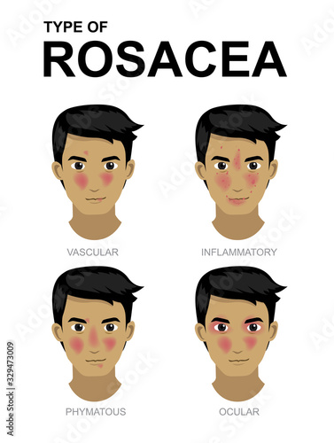 Manga Cartoon Type of Rosacea Man Set