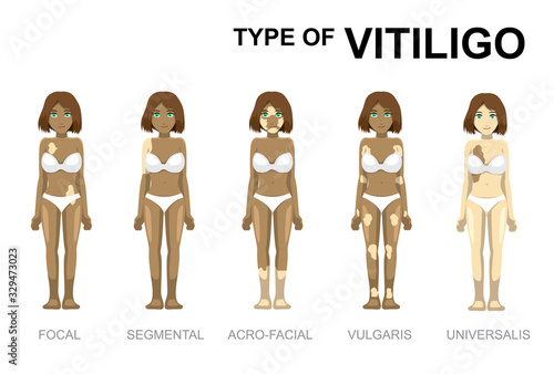Manga Cartoon Type of Vitiligo Woman Set