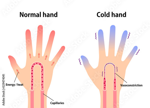 Comparison illustration of normal hand and cold hand ( sensitivity to cold, cold fingertips)