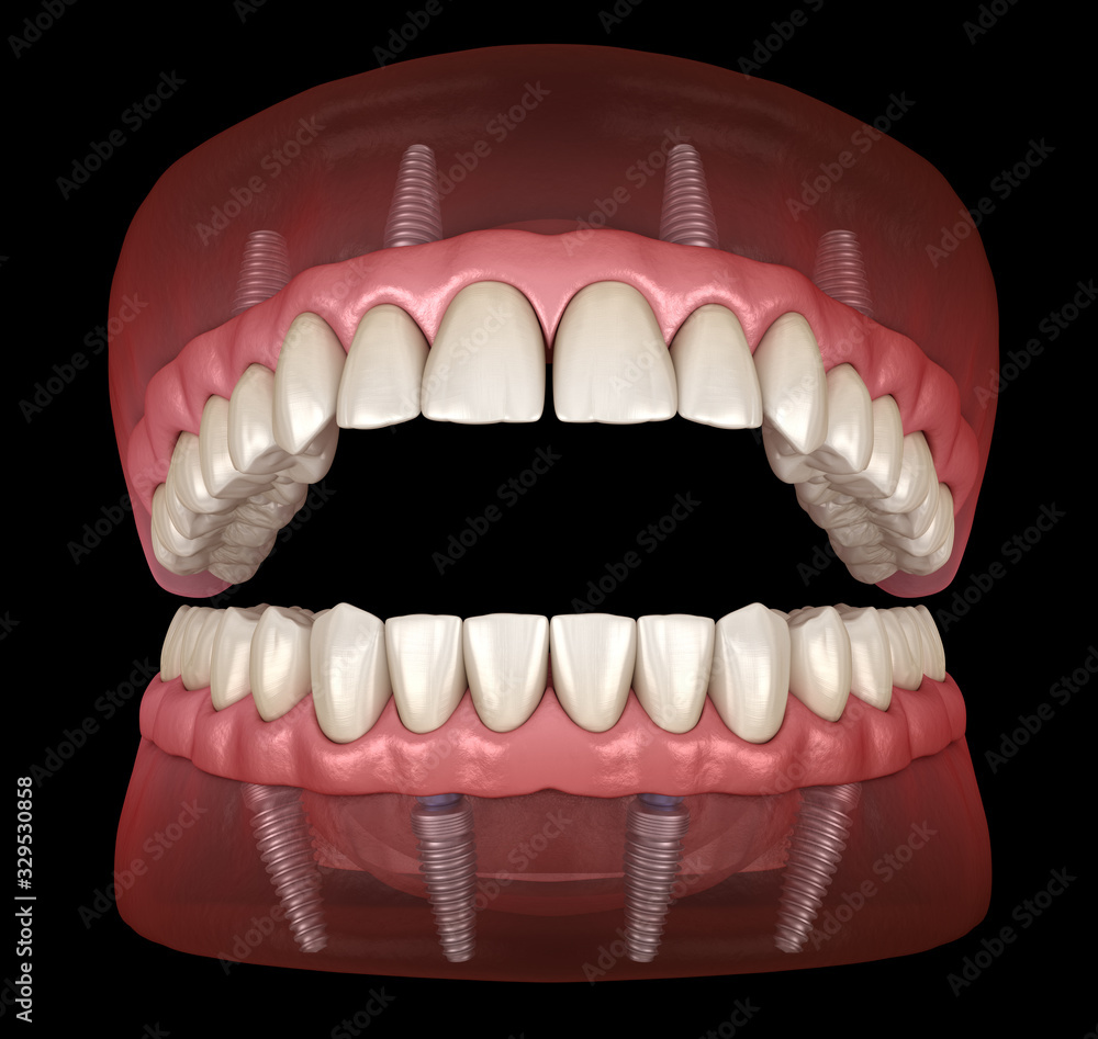 Obraz premium Maxillary and Mandibular prosthesis with gum All on 4 system supported by implants. Medically accurate 3D illustration of human teeth and dentures