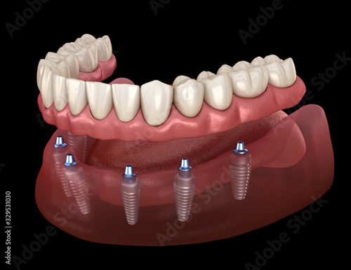 Mandibular prosthesis All on 6 system supported by implants. Medically accurate 3D illustration of human teeth and dentures concept
