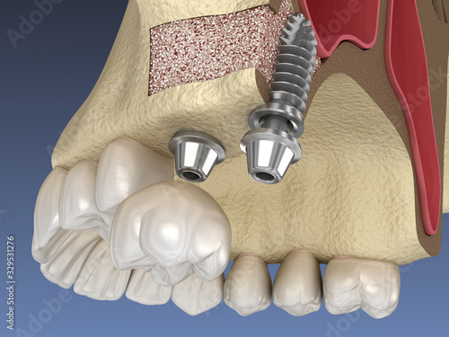 Fotografie Sinus Lift Surgery - implant installation. 3D illustration