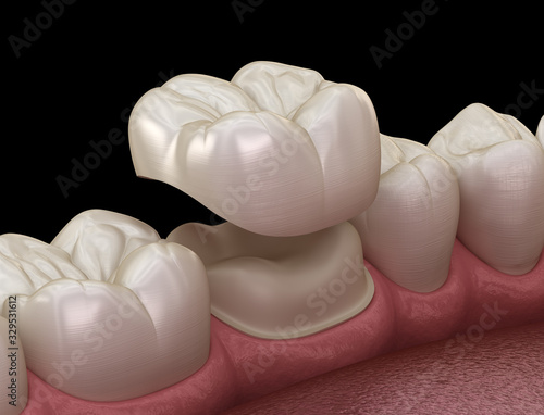 Fototapeta Naklejka Na Ścianę i Meble -  Preparated molar tooth for dental crown placement. Medically accurate 3D illustration