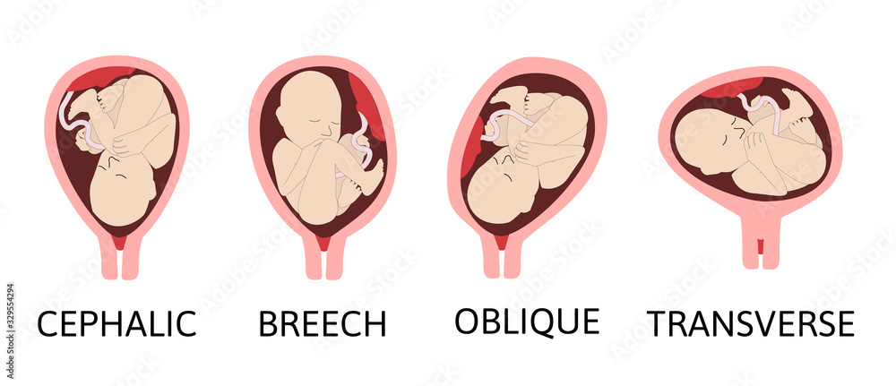 cephalic presentation of pregnancy