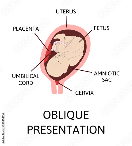 Different baby positions in the uterus during pregnancy.