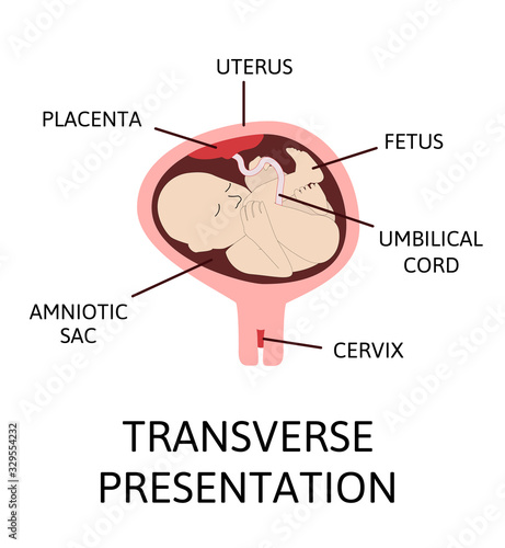Different baby positions in the uterus during pregnancy.