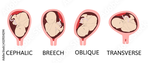Different baby positions during pregnancy. Cephalic, Breech, transverse, Oblique lies. Colored medical vector illustration.
