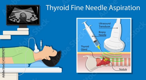 Thyroid cancer disease nodules ultrasound screening check medical treat fine needle aspiration lumps test lab gland neck pain Graves FNA FNAB Large Toxic diagnostic exam collect lymph nodes cell