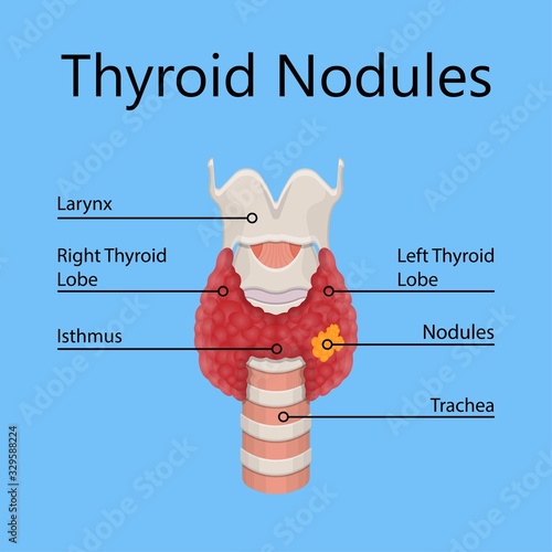 Thyroid cancer disease nodules ultrasound screening check medical treat fine needle aspiration lumps test lab gland neck pain Graves FNA FNAB Large Toxic diagnostic exam collect lymph nodes cell